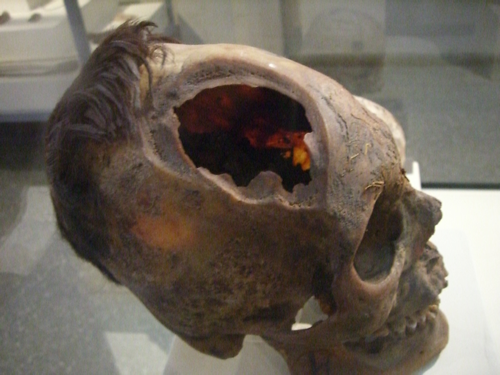 Crani amb extensa trepanació i signes de regeneració.