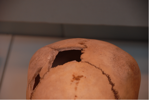 Crani trepanat.