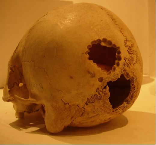 Crani amb trepanació per barrinat