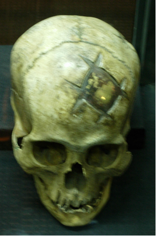Crani amb trepanació inacabada per el mètode de incisió