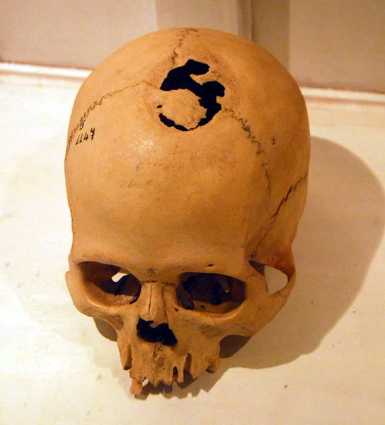 Crani trepanat amb signes de regeneració òssia.