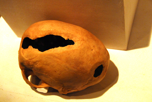 Trepanació per abrassió